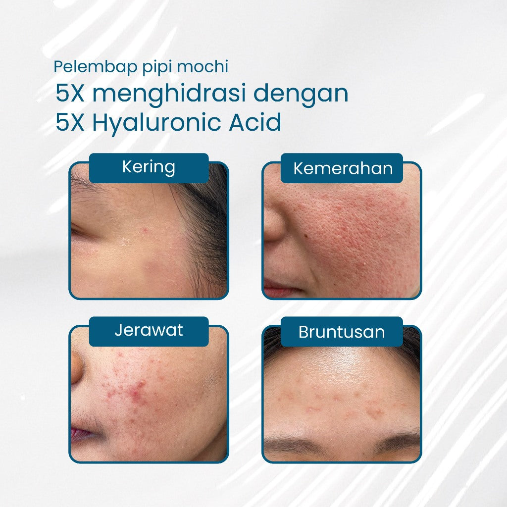 5x Hyaluronic Moisture Lock Gel | Pelembap Muka | Meredakan Kulit Kering | Hyaluronic Acid | Mengurangi kemerahan | Menghilangkan Jerawat