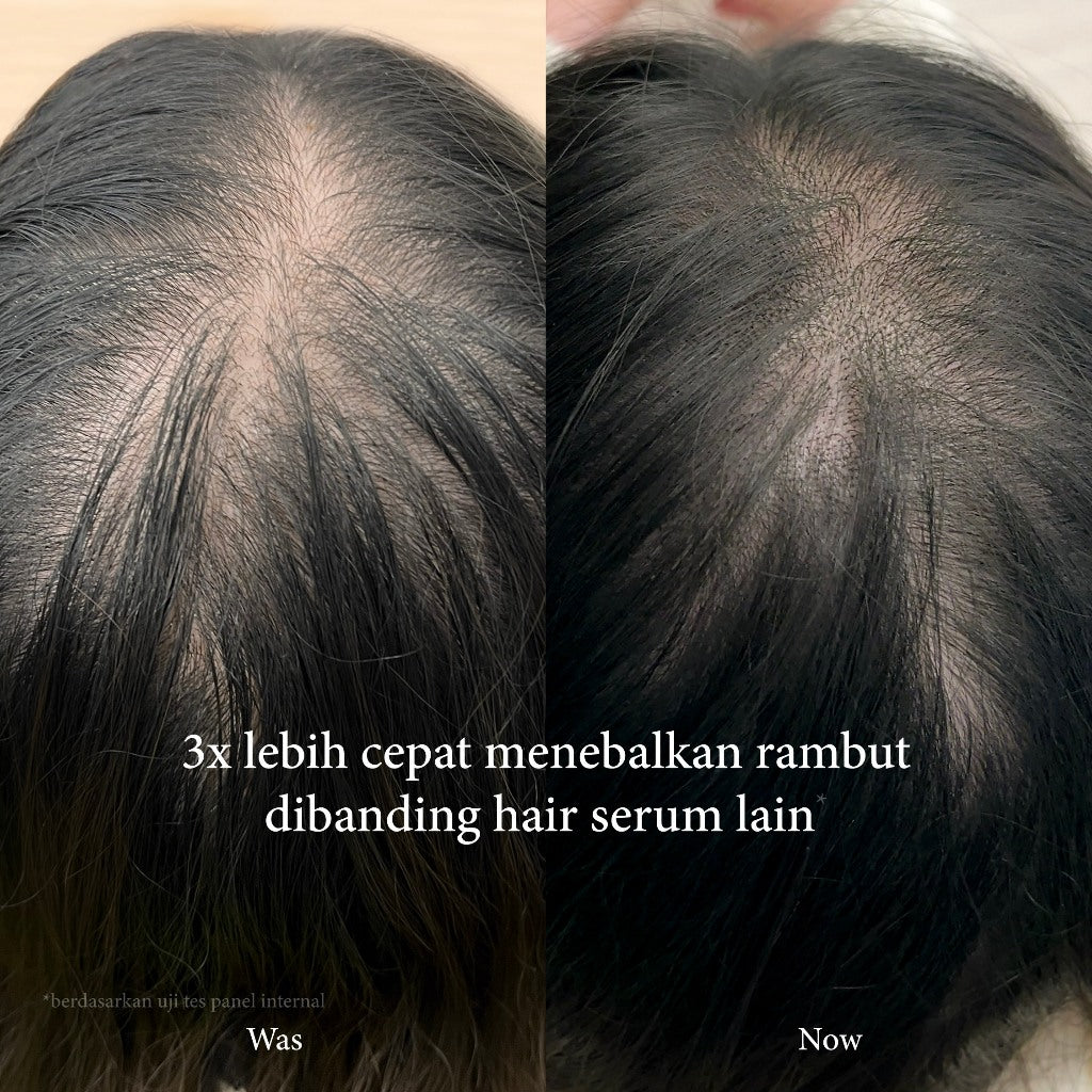 SH-RD Essence Intensif Penumbuh Rambut 50ml | Hair Essence | Penumbuh Rambut | Hair Fall | Rambut rontok | Rambut tipis | Kebotakan | Sensitive Scalp | Volumizing & Anti Lepek | Haircare