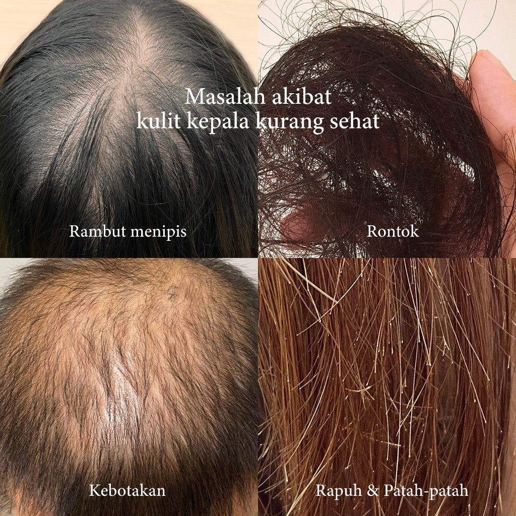 SH-RD Essence Intensif Penumbuh Rambut 50ml | Hair Essence | Penumbuh Rambut | Hair Fall | Rambut rontok | Rambut tipis | Kebotakan | Sensitive Scalp | Volumizing & Anti Lepek | Haircare