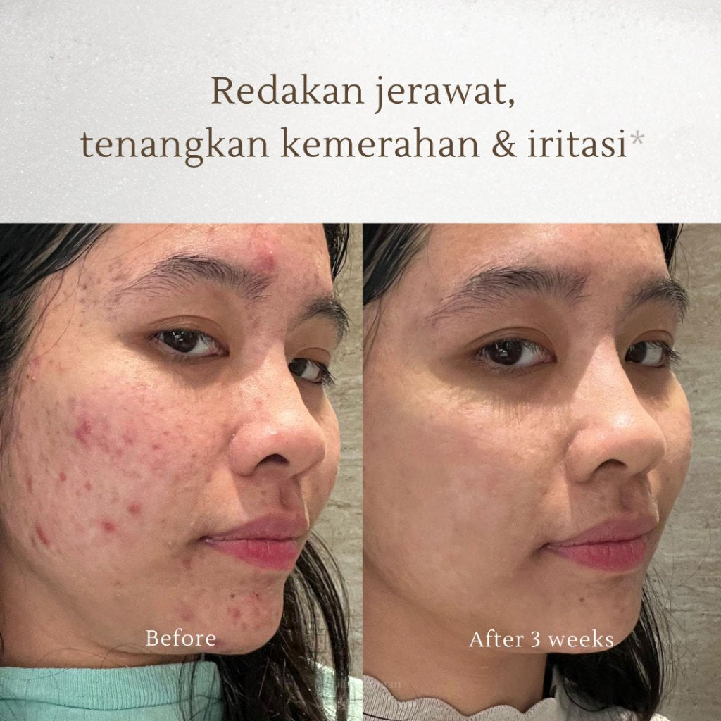 GBELLE | Face wash 3 in 1 Acne Mousse 150ml | Pembersih Wajah | Facial Wash | Face Massage | Kulit Berjerawat | Kulit Iritasi | Kemerahan | Melembapkan | Hydrating | Jerawat | Salicylic Acid