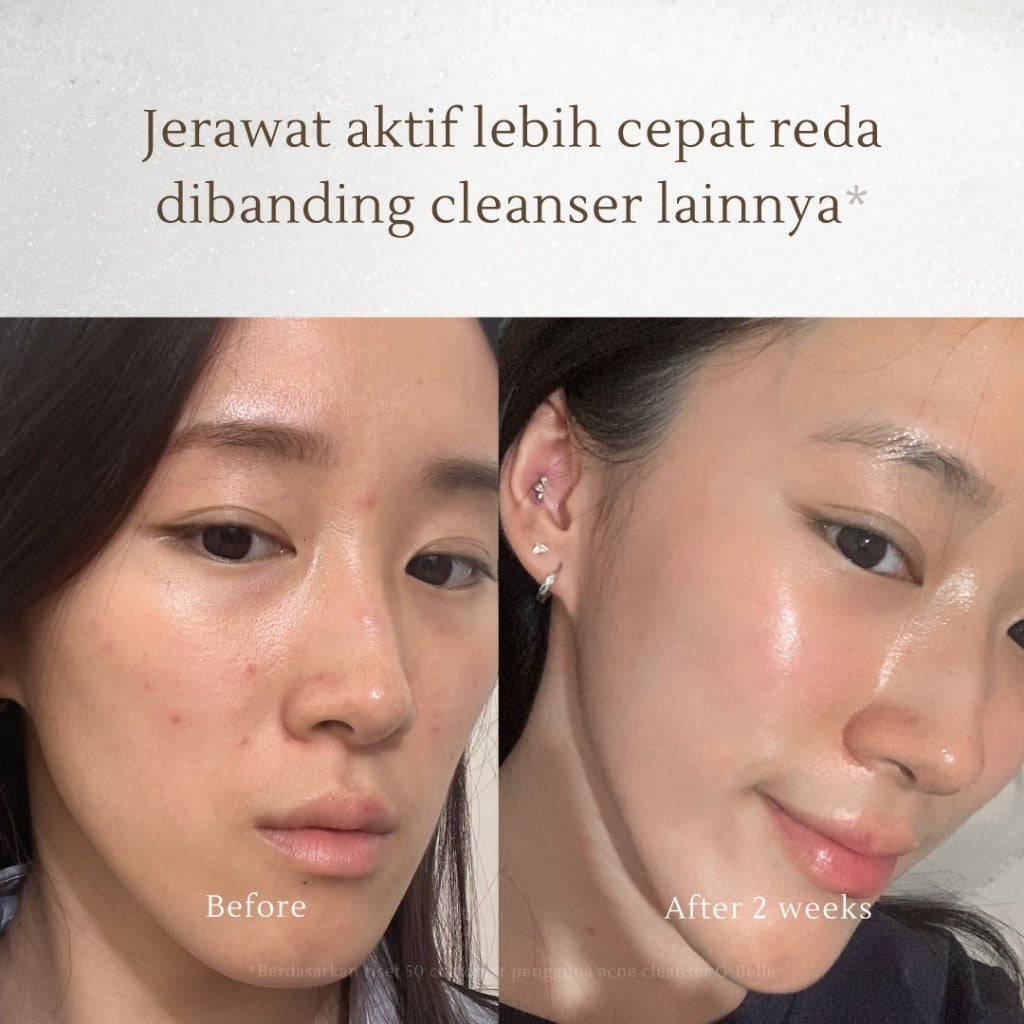 GBELLE | Face wash 3 in 1 Acne Mousse 150ml | Pembersih Wajah | Facial Wash | Face Massage | Kulit Berjerawat | Kulit Iritasi | Kemerahan | Melembapkan | Hydrating | Jerawat | Salicylic Acid